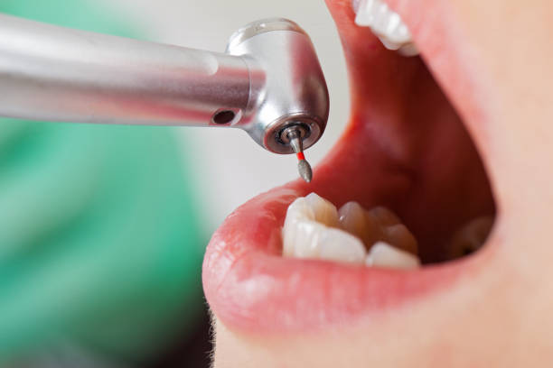 Best Emergency Root Canal Treatment in Plummer, ID